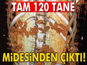 Midesinden 120 kapsül içinde 640 gram esrar çıktı